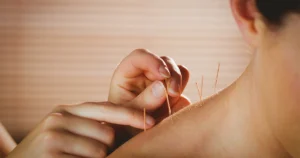 Acupuncture Movement in Mississauga