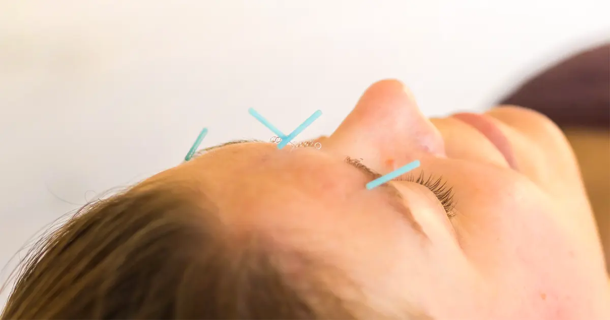 Cosmetic Acupuncture in Mississauga A Clinical Alternative to Botox