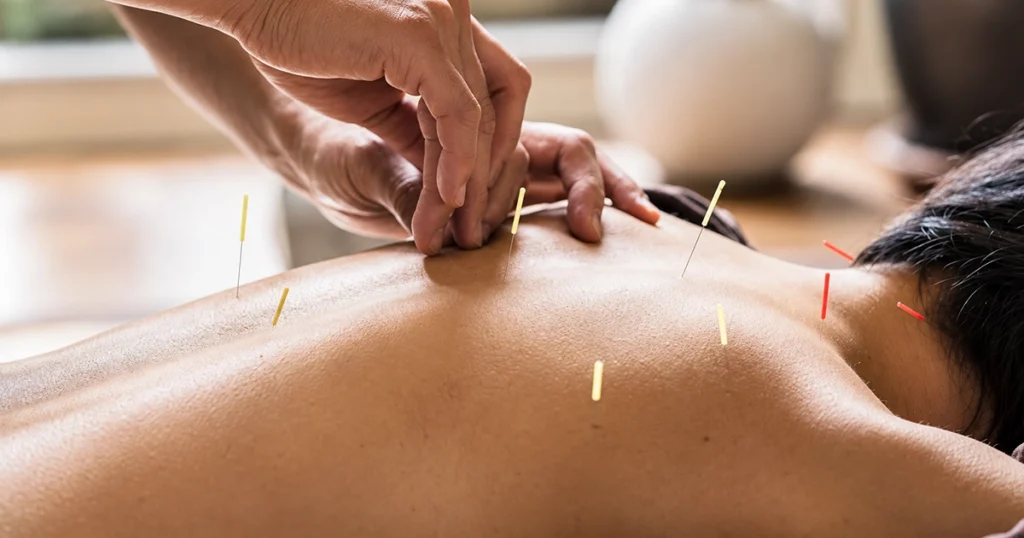 Registered acupuncturist providing safe acupuncture care in Mississauga